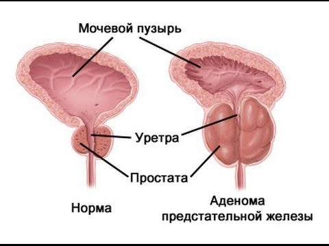 Доброкачественная гиперплазия предстательной железы