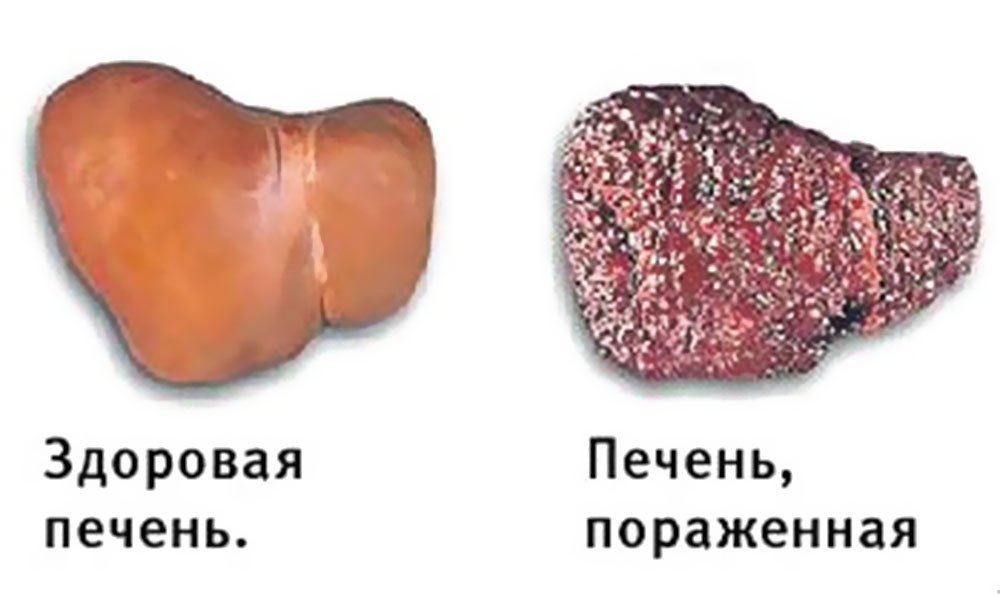 Гепатит Гепатит