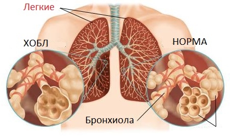 Хроническая обструктивная болезнь легких (ХОБЛ)