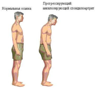 Основные проявления анкилозирующего спондилоартрита