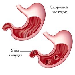 Язвенная болезнь желудка и двенадцатиперстной кишки