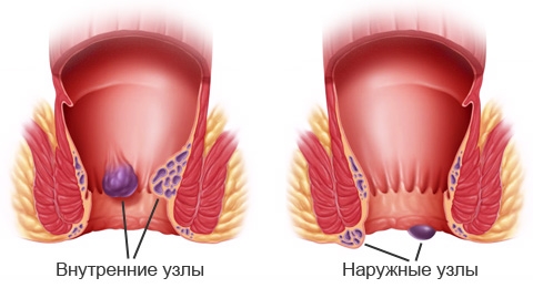 Геморрой