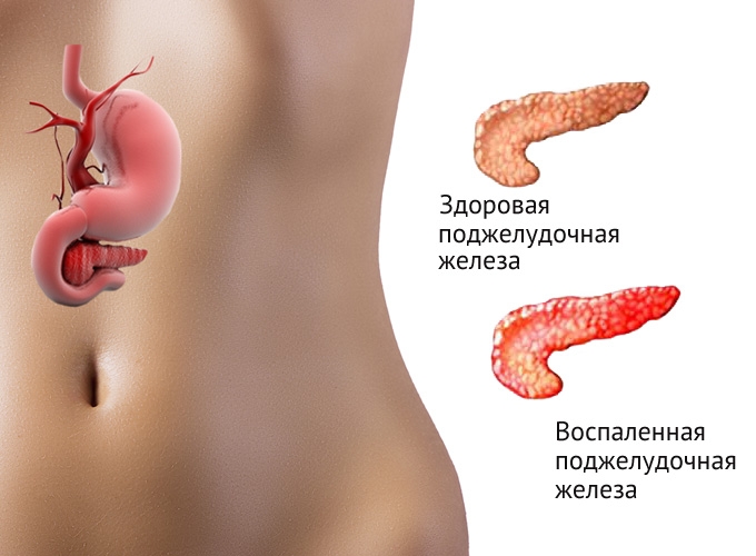 Хронический панкреатит Хронический панкреатит