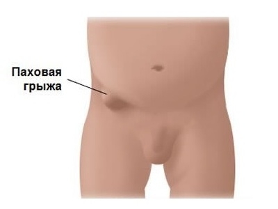 Паховая грыжа Паховая грыжа
