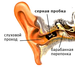 Удаление серных пробок на дому